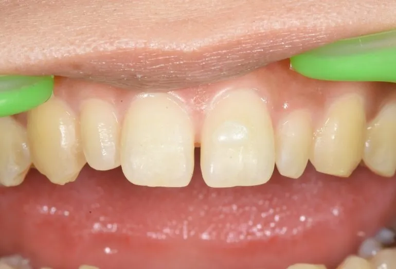 ●ダイレクトボンディング症例●