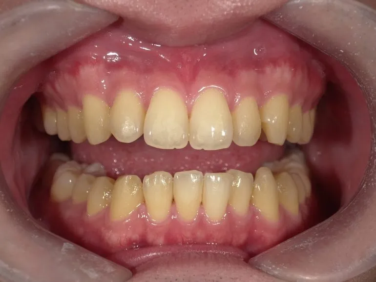 ●ホワイトニング症例●