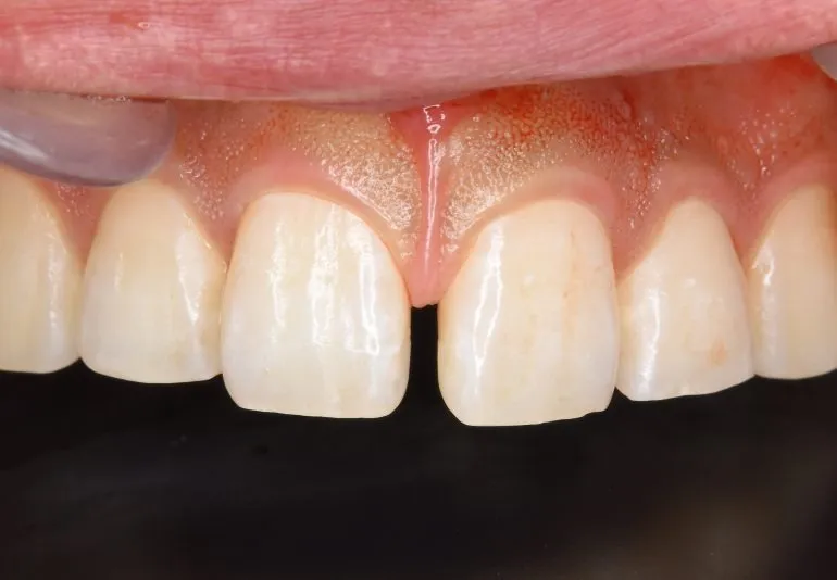 ●ダイレクトボンディング症例●その2