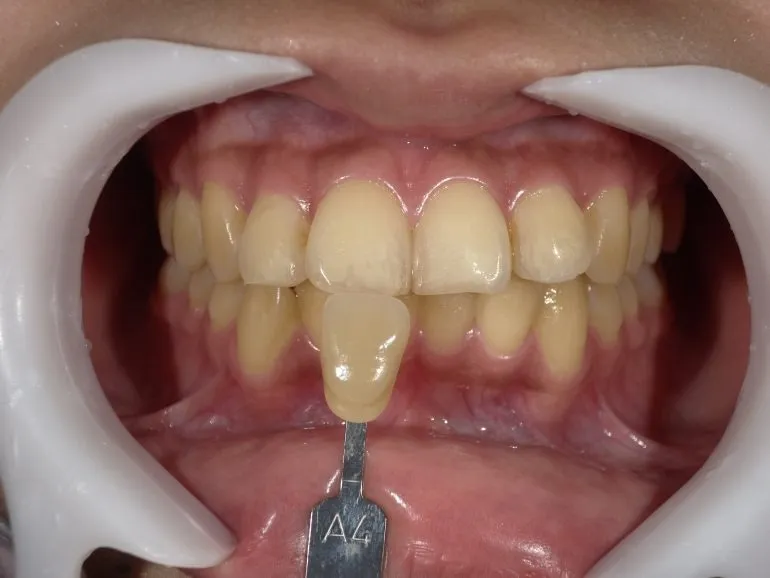 ホワイトニング日記①〜後戻りについて〜