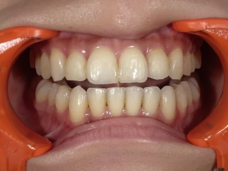 ホワイトニング日記②〜歯のクリーニング〜