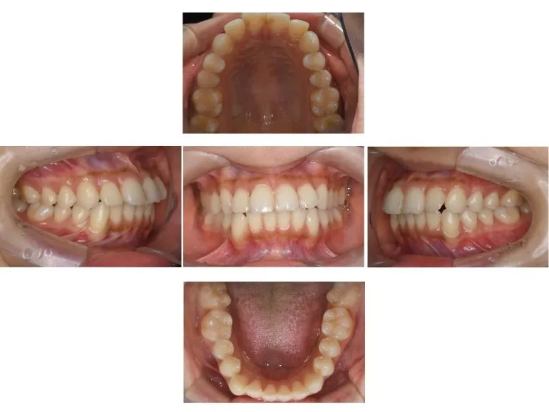 人生2回目の矯正を終えて。