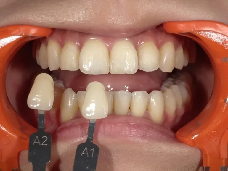 ホワイトニング日記③〜ブリーチシェードへの挑戦〜