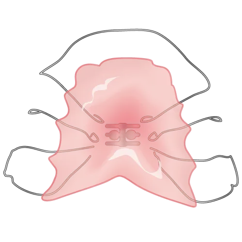 小児矯正に矯正について〜器具の違い〜