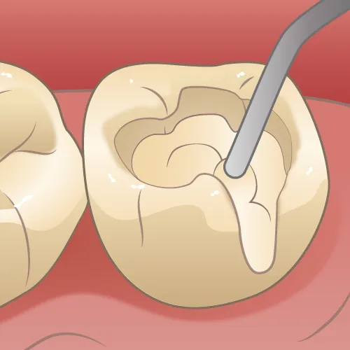 結局どれがいいの？被せ物種類について