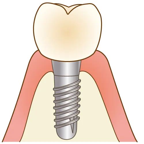 インプラントって？②〜手術の流れ編〜