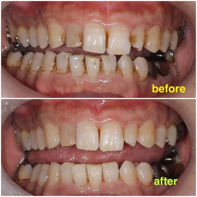 クリーニングアップグレード！EMS導入いたします…！！