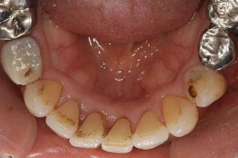 出会いの春！ホワイトニングで印象アップ狙えます！！