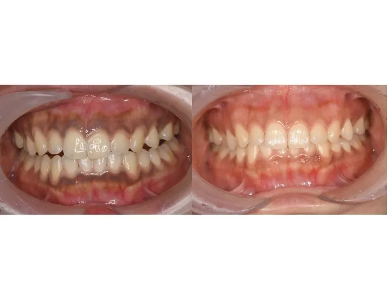 ガムピーリングってご存じですか？