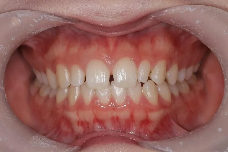 ダイレクトボンディング症例