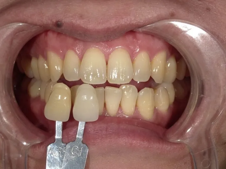 夏のホワイトニングキャンペーン！今がチャンスです